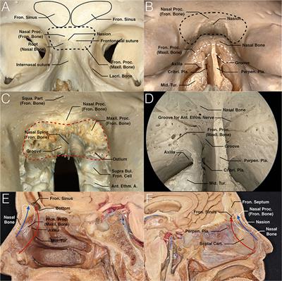 Trans-Nasion-Complex Approach for Endoscopic Modified Lothrop Procedure: Conception, Anatomy, and Technique